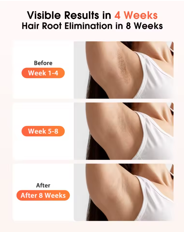 IPL Hair Removal Laser - 3 in 1